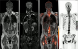 ISMRM: PET/MRI提高了臨床癌癥成像的價值